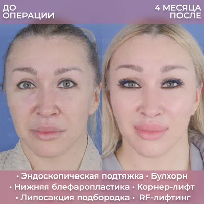 Эндоскопическая подтяжка лба и бровей в VIP Clinic. Цены на лифтинг указаны  в прайсе-листе