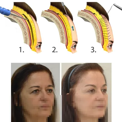 Эндоскопический лифтинг лба, Эндоскопическая подтяжка лба, темпоропластика.  Цены