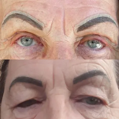 Подтяжка бровей / Brow lift в Москве в Damas Medical Center