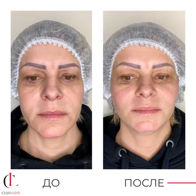 Подтяжка лица нитями в Москве: цены, фото и отзывы - клиника Cleo Line