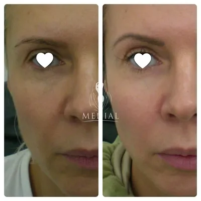 Фото \"до и после\" нитевого лифтинга: примеры подтяжки лица нитями и  нитевого армирования от врачей косметологии Груздева