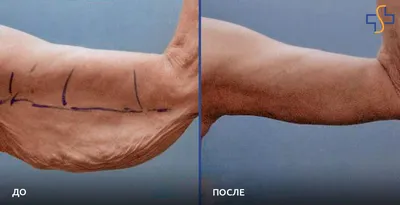 Подтяжка рук (брахиопластика) фото до и после