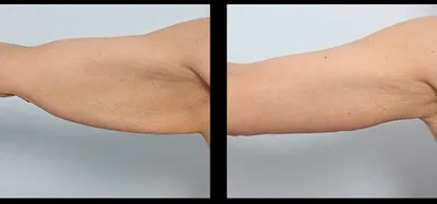 Пластика рук (брахиопластика) → Фото результатов до и после пластической  операции