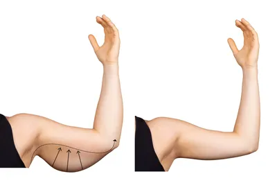 Не хирургическая подтяжка рук BodyTite → Фото результатов до и после  пластической операции