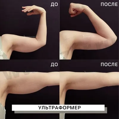 ᐉ Фото до и после — липофилинг кистей рук, фотографии до и после операции  липофилинг кистей рук, фото результатов операции