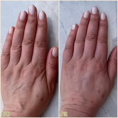 Брахиопластика - подтяжка кожи рук: цена, клиника, отзывы | Интернет-журнал  Estetmedicina.ru