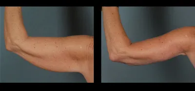 Подтяжка рук (фото до и после) | MedEssentially | Дзен