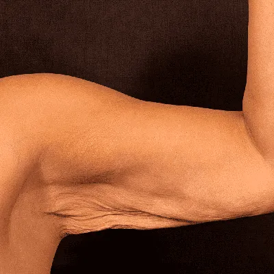 Хирургическая подтяжка кожи рук (Брахиопластика) - Курбанова Зарема Вахаевна
