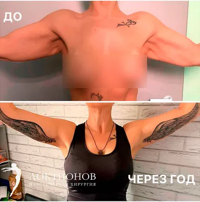 Брахиопластика (подтяжка рук, лифтинг рук) в Москве | Цены у пластического  хирурга, фото до и после