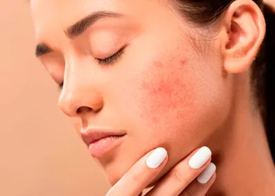 От чего возникает покраснение кожи лица и как бороться с гиперемией