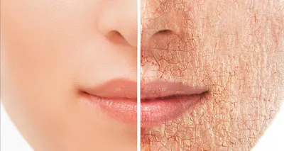 Борьба с раздражением кожи: must have средств по уходу за лицом и телом при  покраснении и шелушении