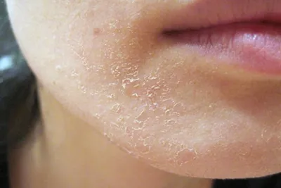 Шелушение кожи на лице: все, что вы хотели знать о проблеме