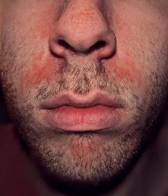 Покраснение и шелушение кожи на лице у мужчин фото фото