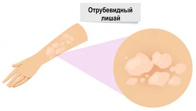 Как вылечиться от себореи и себорейного дерматита — блог медицинского  центра ОН Клиник