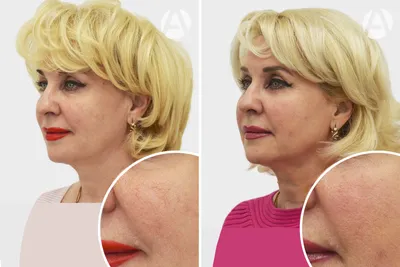 Атопический дерматит на лице и теле у взрослых - лечение в СПб