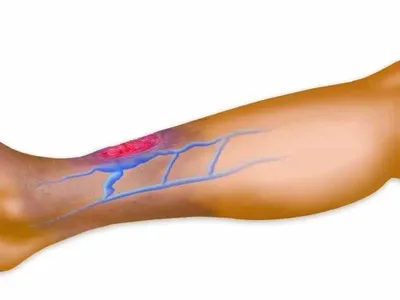 Трещины между пальцами ног – причины и лечение