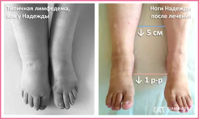 Почему чешутся ноги: зуд ступни, пятки? Какие причины и что делать? —  phlebo1.ru