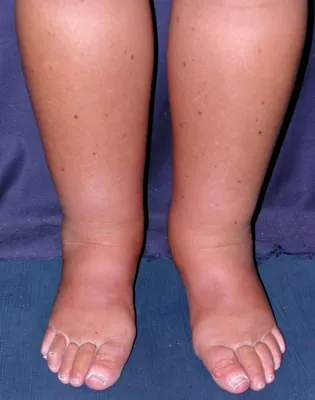 Раздражение кожи ног - Вопрос дерматологу - 03 Онлайн