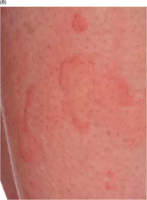 Покраснение кожи на левой ноге ниже икры - Вопрос дерматологу - 03 Онлайн