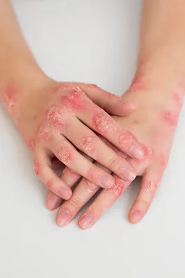 Воспаление кожи на руках - Вопрос дерматологу - 03 Онлайн