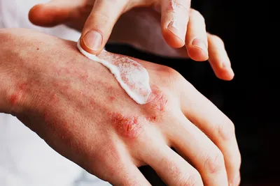 Центр Здоровья Кожи - Атопический дерматит – воспалительное хроническое  заболевание кожи, вызывающее кожный зуд, покраснение, утолщение и сухость  кожного покрова. Чаще всего пораженные участки появляются на лице, руках,  ногах, внутреннем сгибе локтя,
