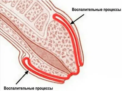 Покраснение головки члена. Причины баланита и баланопостита • 36,6