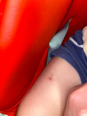 Красная точка после прививки АКДС не проходит уже полгода — 7 ответов |  форум Babyblog