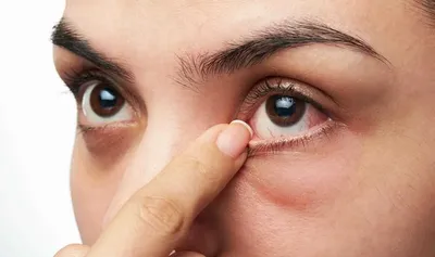 Покраснение кожи вокруг глаз: причины, симптомы и лечение