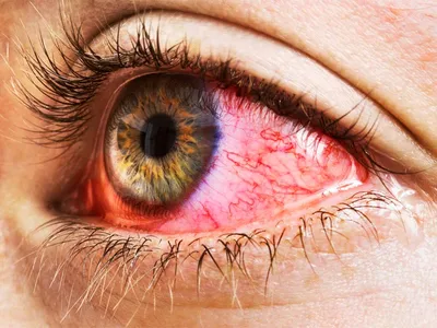 Покраснение глаз – первый симптом ковида? – [Клиника доктора Куренкова]