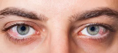 Покраснение глаз - когда нужно обратиться к врачу | Украинский  офтальмологический портал