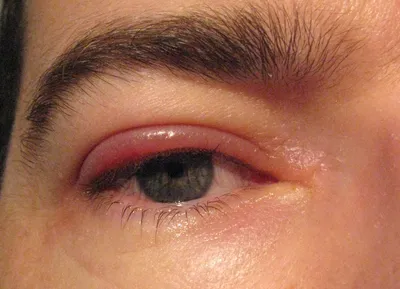 Шелушение вокруг глаз: причины и лечение
