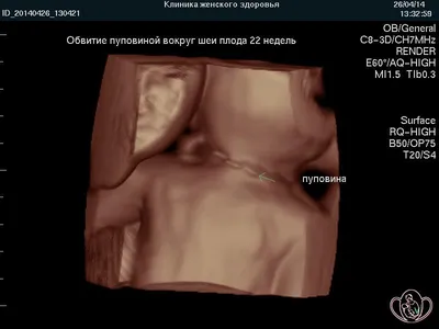 УЗИ плода на 14-й – 15-й неделе беременности.