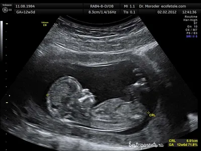 УЗИ 14 недель. Пол малыша. — 24 ответов | форум Babyblog