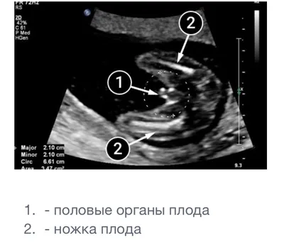 Комбинированный скрининг I триместра беременности