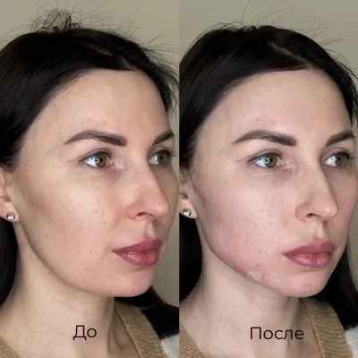 Нитевой лифтинг: топ вопросов и ответов - Cosmetic-clinic