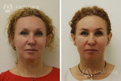 Мастер класс инъекций препарата Aesthefill | VARA +7 (978) 550-25-92