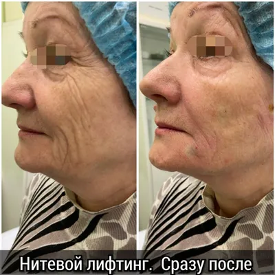 Контурная пластика филлером AestheFill в Москве — цена в клинике Ланцетъ