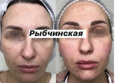 Kiara_Reju - 💉Kiara Reju PDRN Полинуклеотиды (ПДРН) стали настоящей  сенсацией в мире косметологии ❤ ⠀ ☝️Полинуклеотиды являются именно теми  «кирпичиками», которые восстанавливают структуру кожи изнутри, повышая  выработку коллагена. ➡️Действие ...