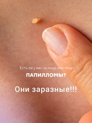 КЛИНИКА «MEDIA MED » ШЫМКЕНТ on Instagram: \"Если на вашем теле есть  папилломы - на шее, подмышках или в любых других местах – паразиты поедают  ваши органы! Наличие папиллом на коже человека –