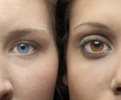 Хирургическое изменение цвета глаз: как это выглядит - Техно | Сегодня