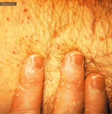 Пластырь с микроиглами вылечит болезни кожи, вызванные золотистым  стафилококком