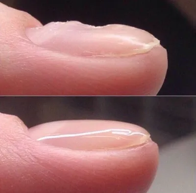 Аппаратный педикюр SUDA \"Зюда\" - ✍🏻НА ЗАМЕТКУ: Онихолизис (onycholysis) -  полное или частичное отделение ногтевой пластинки от ногтевого ложа.  Отделение ногтя от ногтевого ложа чаще всего происходит со свободного края,  но может