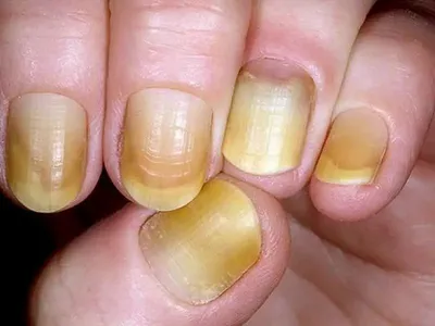 Симптом наперстка на ногтях – причины, методы лечения и профилактики