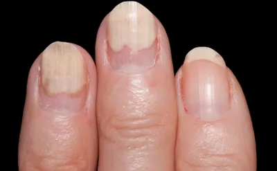 Симптомы диабета: признак на ногтях, сигнализирующий о развитии болезни