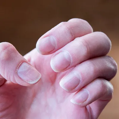 Не упустите из виду: эти изменения на ногтях могут предупреждать о сахарном  диабете - Чемпионат