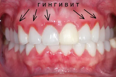 Трофические язвы: причины, симптомы, лечение | МЦ «Институт Вен»