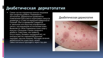 Синдром диабетической стопы - СПАСЕНИЕ ЕСТЬ | Medical Plaza