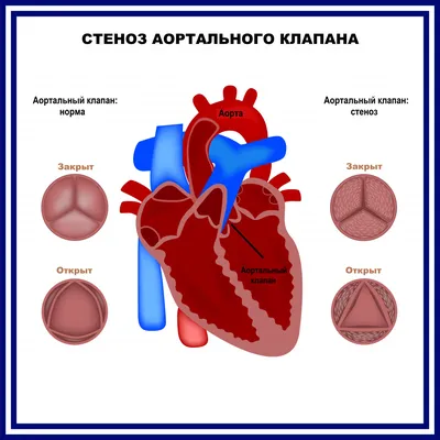 Пороки сердца - причины появления, симптомы заболевания, диагностика и  способы лечения