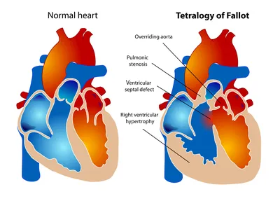Факторы риска развития врожденных пороков сердца | Надежда для сердца | Дзен