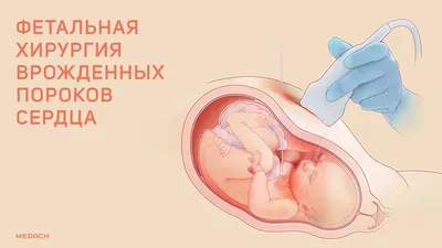 Приобретенные пороки сердца: симптомы и лечение